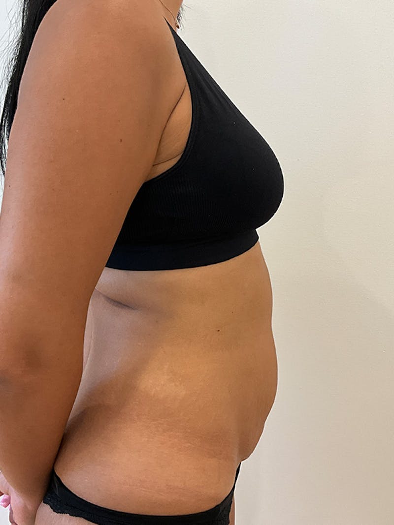 Tummy Tuck Before & After Gallery - Patient 314712 - Image 5