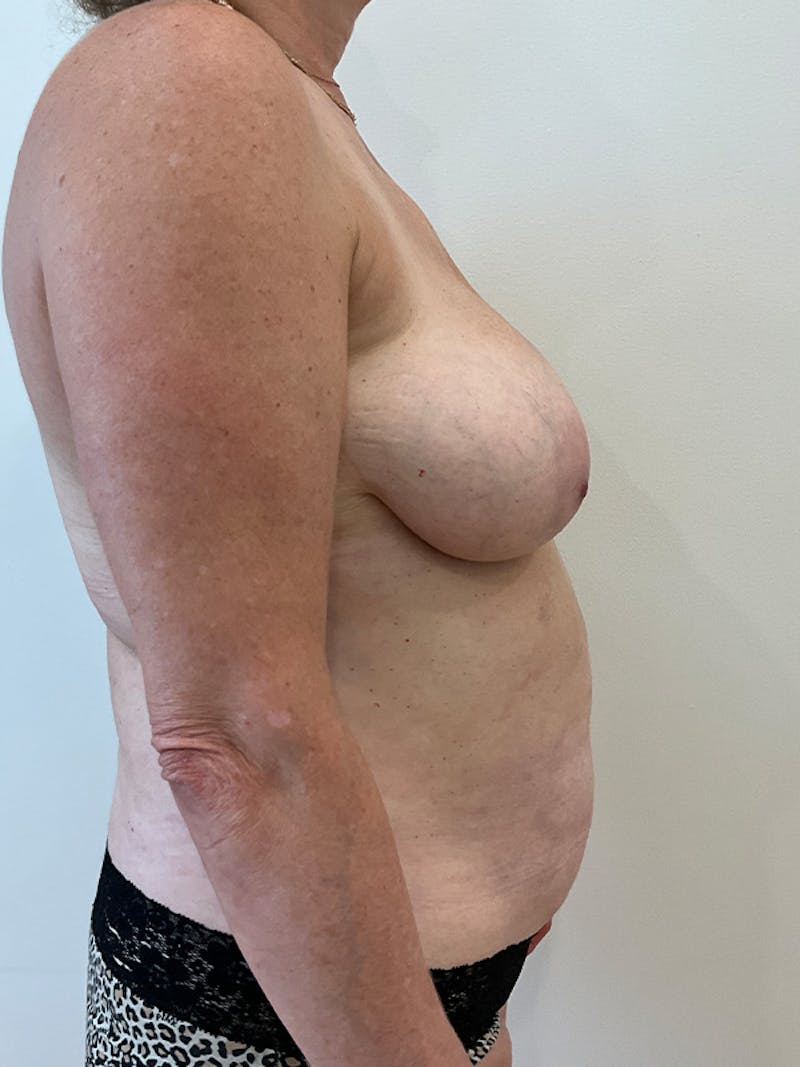 Tummy Tuck Before & After Gallery - Patient 162522 - Image 5