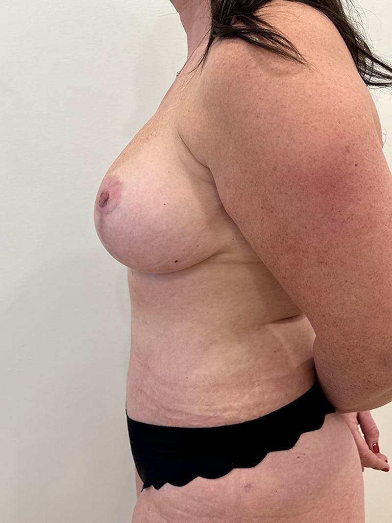 Tummy Tuck Before & After Gallery - Patient 202439 - Image 6