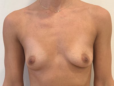 Breast Augmentation Before & After Gallery - Patient 828627 - Image 1