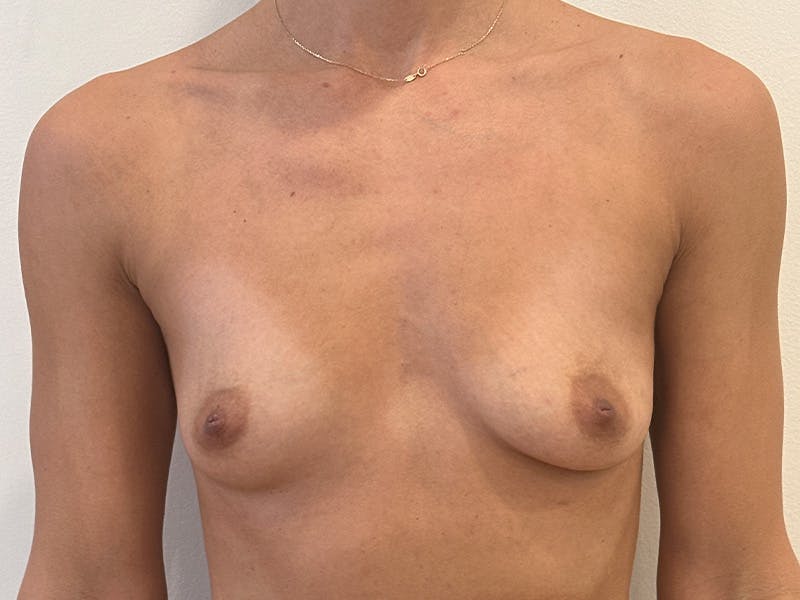 Breast Augmentation Before & After Gallery - Patient 828627 - Image 1