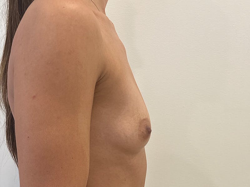 Breast Augmentation Before & After Gallery - Patient 828627 - Image 5