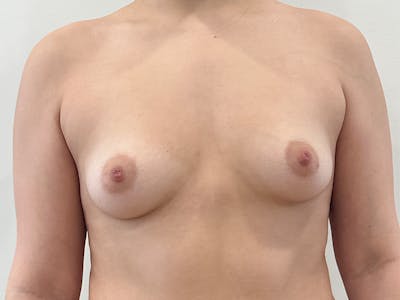 Breast Augmentation Before & After Gallery - Patient 308025 - Image 1