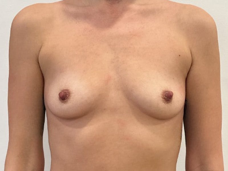 Breast Augmentation Before & After Gallery - Patient 502074 - Image 1