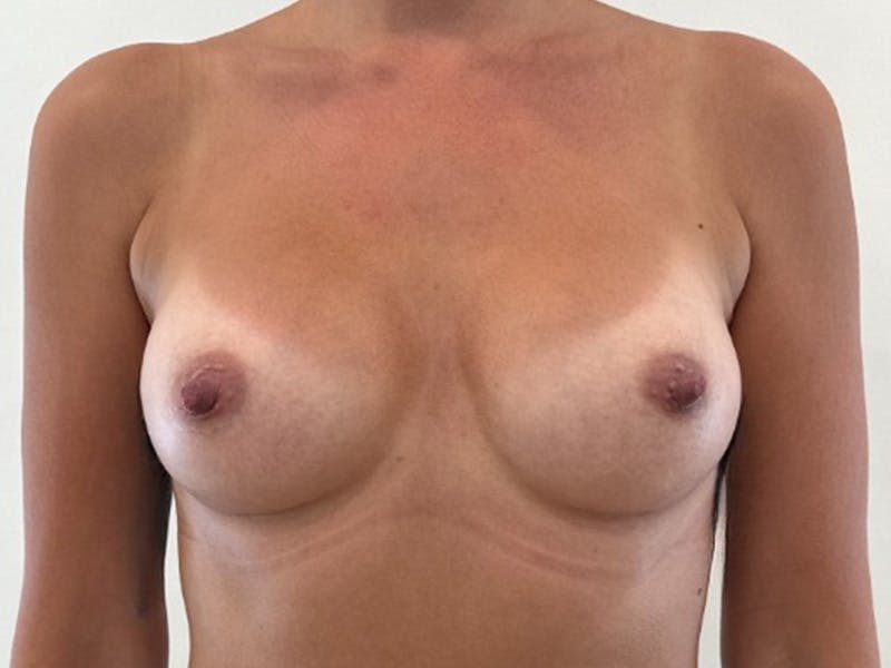 Breast Augmentation Before & After Gallery - Patient 502074 - Image 2