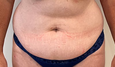 Tummy Tuck Before & After Gallery - Patient 202439 - Image 1