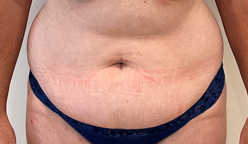 Tummy Tuck Before & After Gallery - Patient 202439 - Image 1