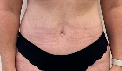 Tummy Tuck Before & After Gallery - Patient 202439 - Image 2
