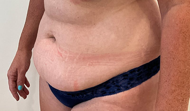 Tummy Tuck Before & After Gallery - Patient 202439 - Image 3