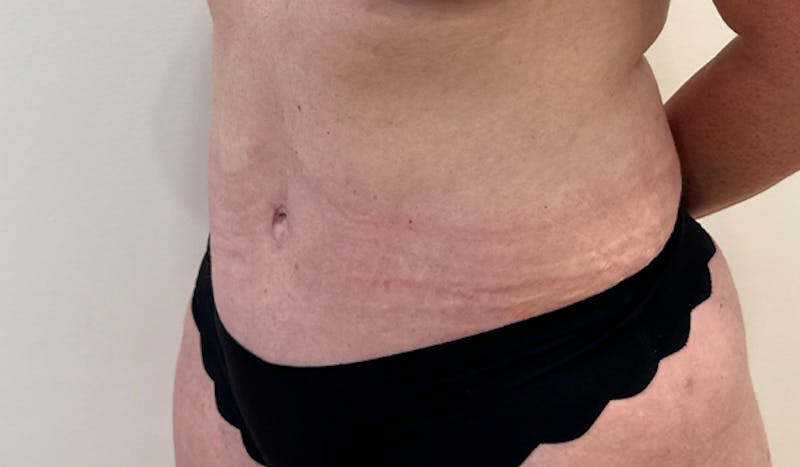 Tummy Tuck Before & After Gallery - Patient 202439 - Image 4