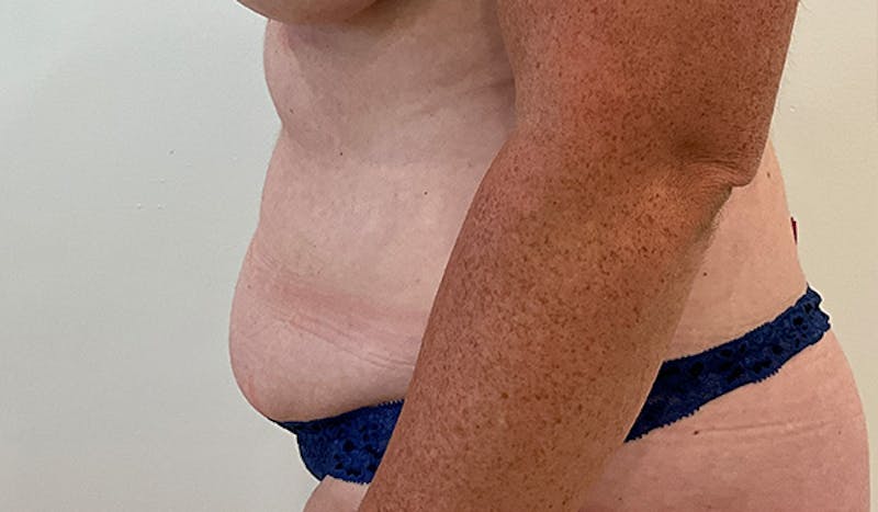 Tummy Tuck Before & After Gallery - Patient 202439 - Image 5