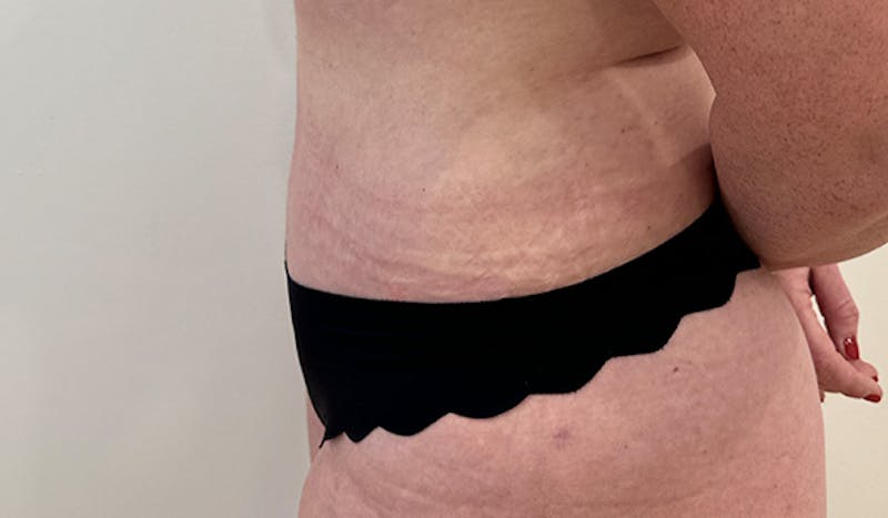 Tummy Tuck Before & After Gallery - Patient 202439 - Image 6