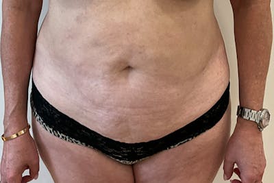 Tummy Tuck Before & After Gallery - Patient 162522 - Image 1
