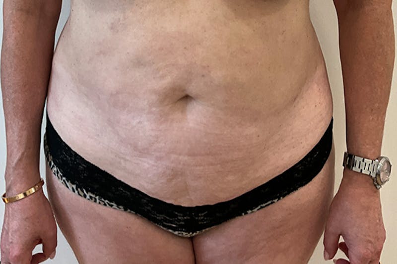 Tummy Tuck Before & After Gallery - Patient 162522 - Image 1