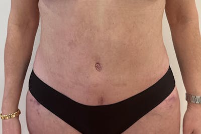 Tummy Tuck Before & After Gallery - Patient 162522 - Image 2