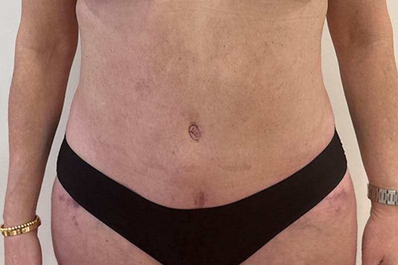 Tummy Tuck Before & After Gallery - Patient 162522 - Image 2