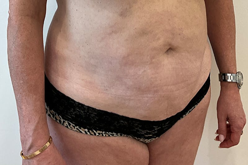 Tummy Tuck Before & After Gallery - Patient 162522 - Image 3