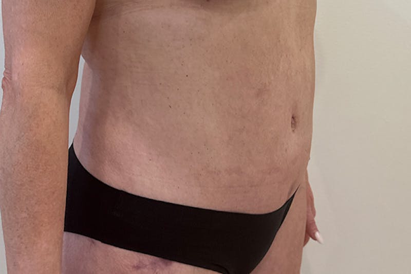 Tummy Tuck Before & After Gallery - Patient 162522 - Image 4