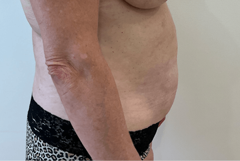 Tummy Tuck Before & After Gallery - Patient 162522 - Image 5