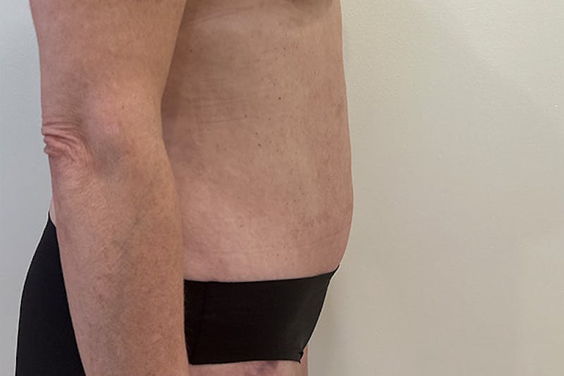 Tummy Tuck Before & After Gallery - Patient 162522 - Image 6