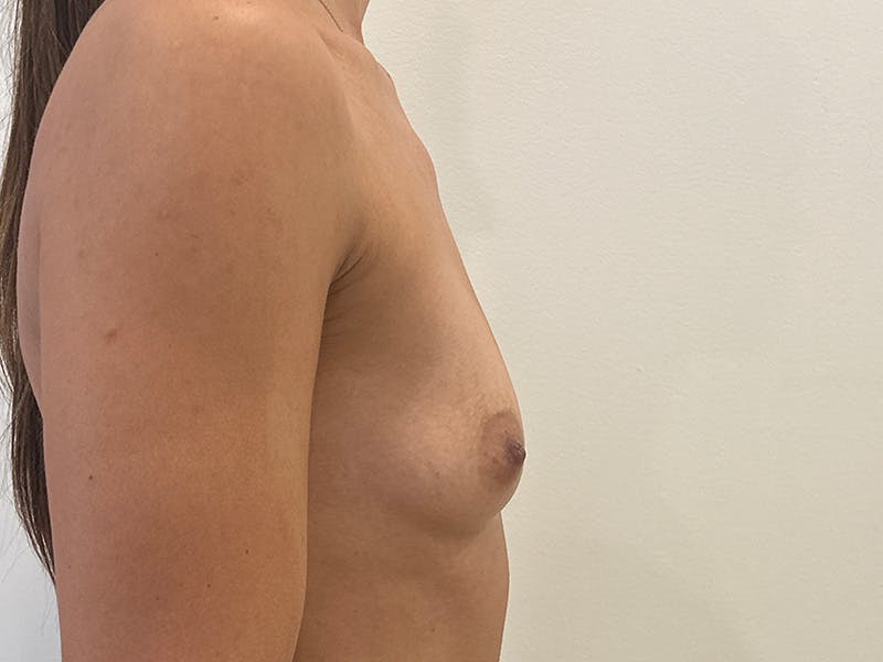 Breast Augmentation Before & After Gallery - Patient 361454 - Image 5