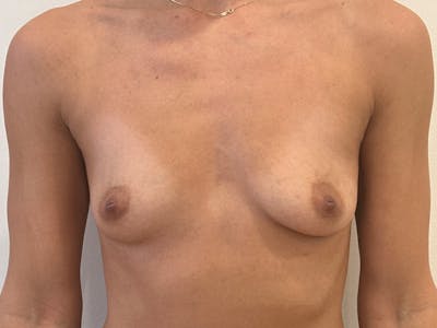 Breast Augmentation Before & After Gallery - Patient 361454 - Image 1