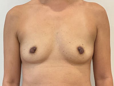 Breast Augmentation Before & After Gallery - Patient 426953 - Image 1