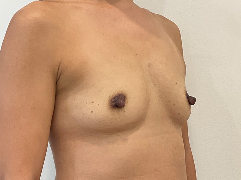 Breast Augmentation Before & After Gallery - Patient 426953 - Image 3