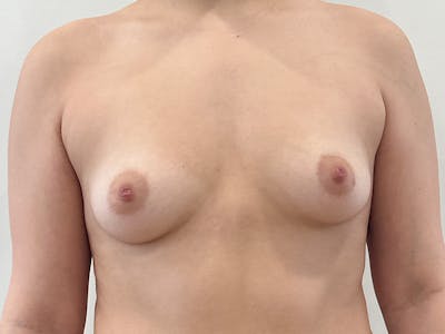 Breast Augmentation Before & After Gallery - Patient 336707 - Image 1