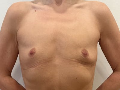 Breast Augmentation Before & After Gallery - Patient 830851 - Image 1