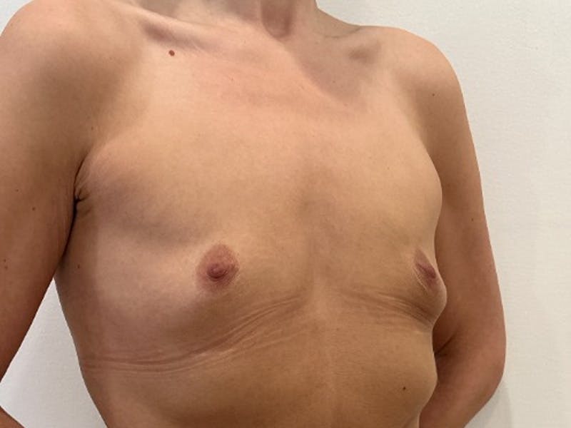 Breast Augmentation Before & After Gallery - Patient 830851 - Image 3