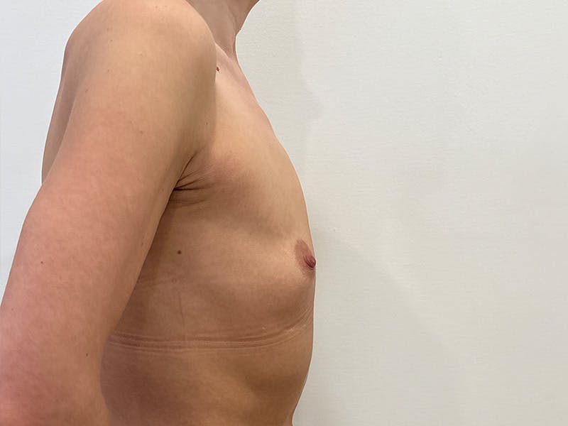 Breast Augmentation Before & After Gallery - Patient 830851 - Image 5