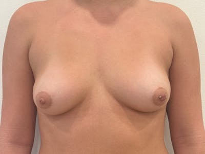 Breast Augmentation Before & After Gallery - Patient 335561 - Image 1