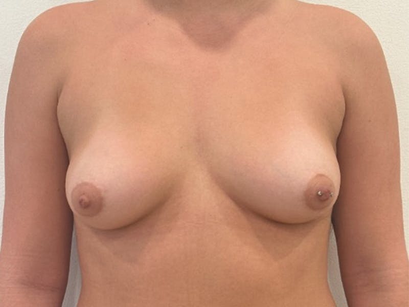 Breast Augmentation Before & After Gallery - Patient 335561 - Image 1