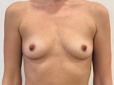 Breast Augmentation Before & After Gallery - Patient 164873 - Image 1