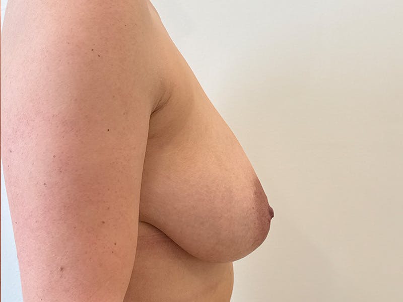 Breast Reduction Before & After Gallery - Patient 165208 - Image 5