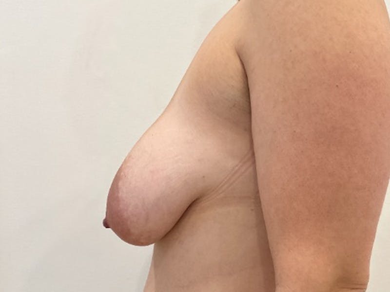 Breast Reduction Before & After Gallery - Patient 293745 - Image 5