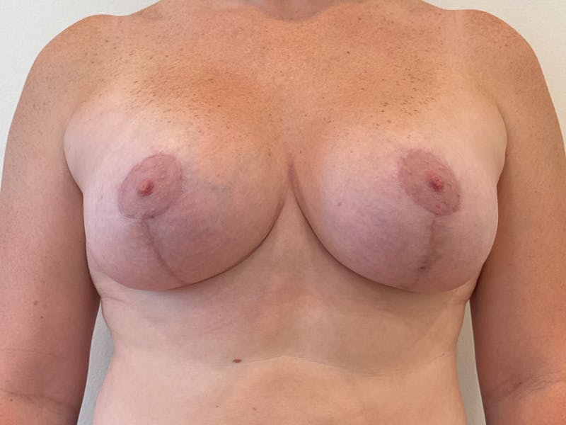 Breast Augmentation and Lift Before & After Gallery - Patient 379655 - Image 2
