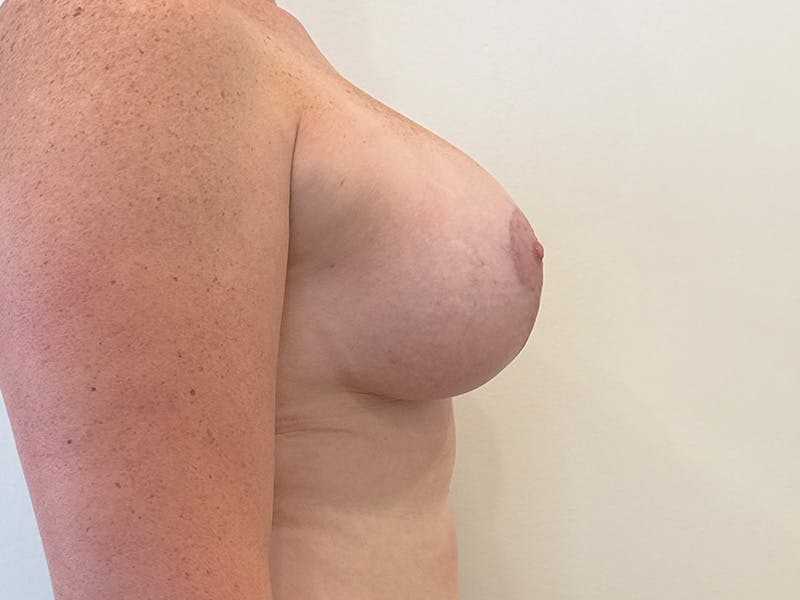 Breast Augmentation and Lift Before & After Gallery - Patient 379655 - Image 6