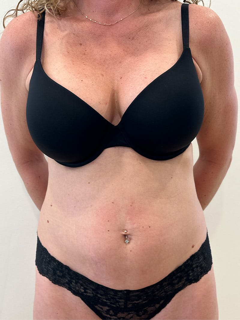 Tummy Tuck Before & After Gallery - Patient 246464 - Image 1