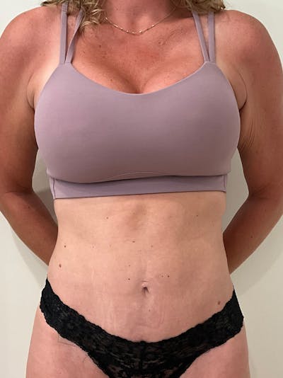 Tummy Tuck Before & After Gallery - Patient 246464 - Image 2