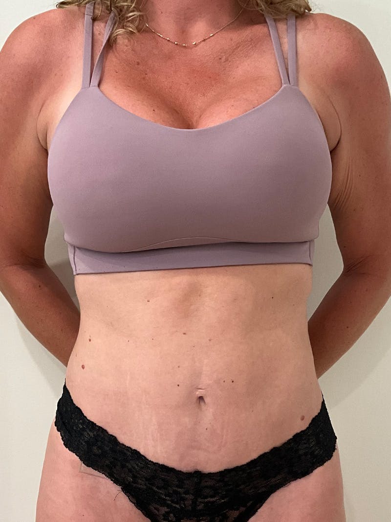 Tummy Tuck Before & After Gallery - Patient 246464 - Image 2