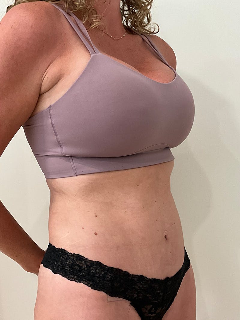 Tummy Tuck Before & After Gallery - Patient 246464 - Image 4
