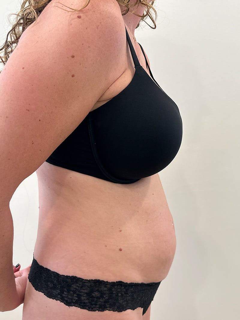 Tummy Tuck Before & After Gallery - Patient 246464 - Image 5