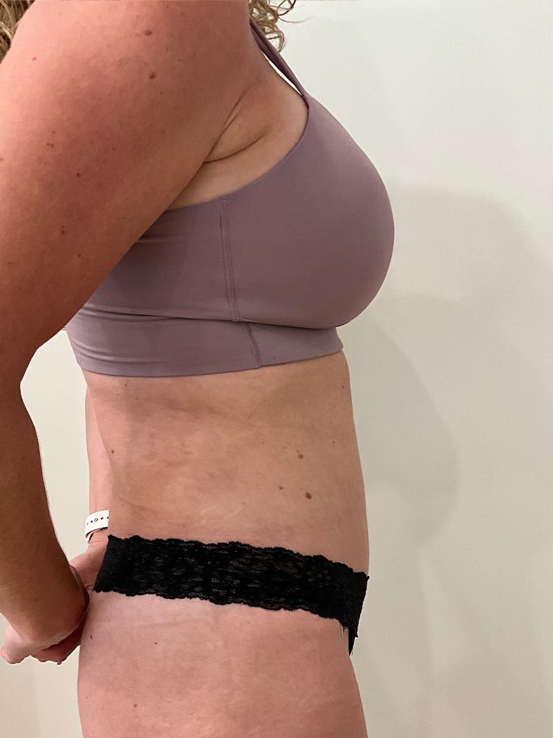 Tummy Tuck Before & After Gallery - Patient 246464 - Image 6