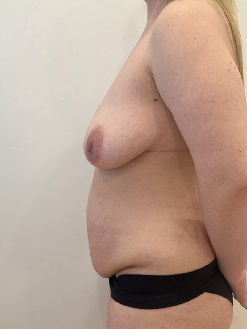 Mommy Makeover Before & After Gallery - Patient 604101 - Image 5