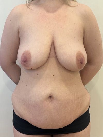 Mommy Makeover Before & After Gallery - Patient 604101 - Image 1