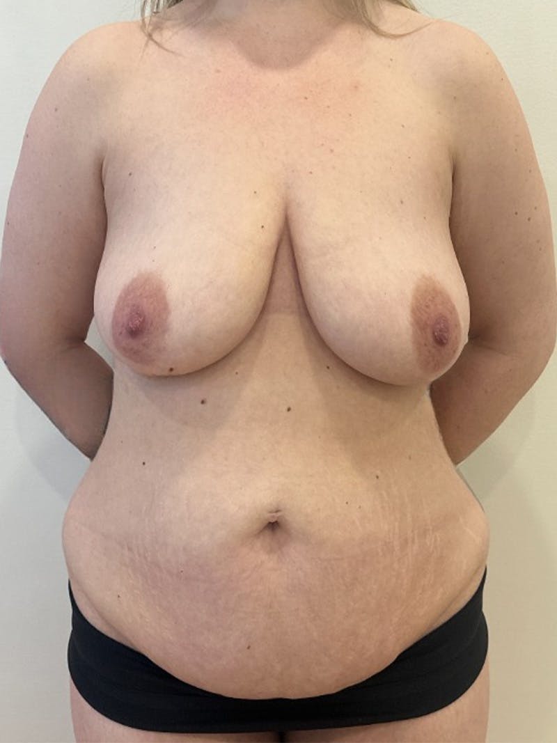 Mommy Makeover Before & After Gallery - Patient 604101 - Image 1