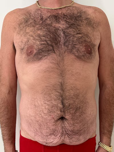 Body Lift Before & After Gallery - Patient 332820 - Image 1