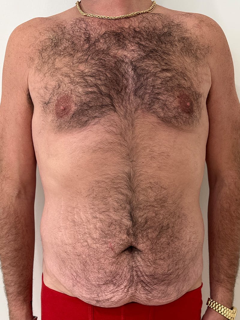 Body Lift Before & After Gallery - Patient 332820 - Image 1